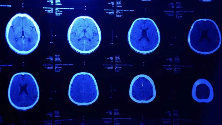 Brains scans showing traumatic brain injury