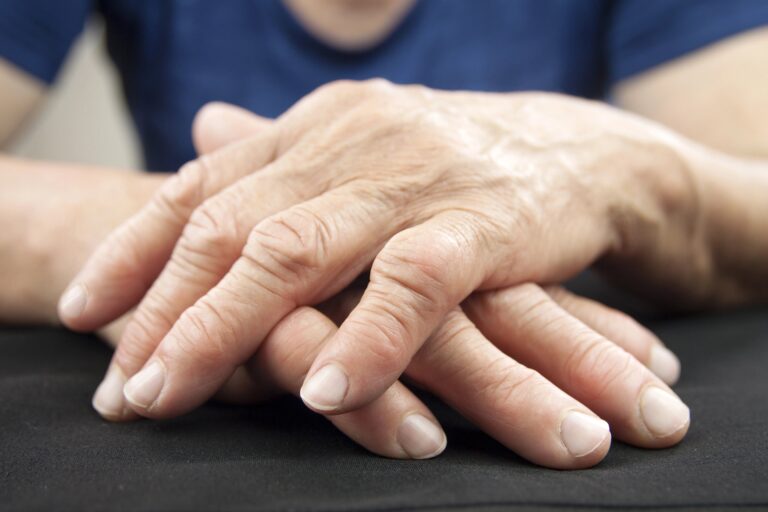 Older female hands affected by arthritis